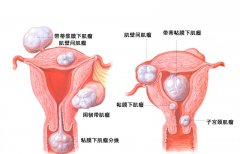 如何治疗子宫肌瘤